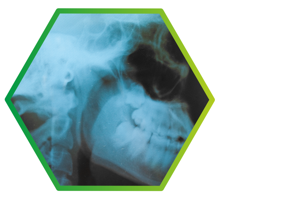рентген черепа ромб.png